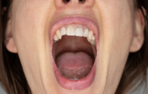 La diabetes y tu salud bucal: cómo afecta y qué hacer para mejorar